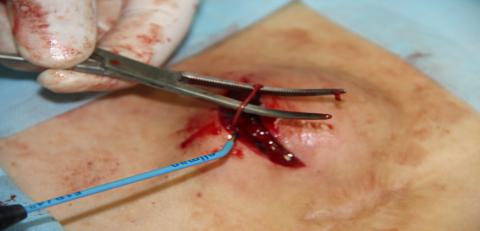 Коагуляции артериального сосуда с применением аппарата РВЧ-хирургии «Сургитрон»