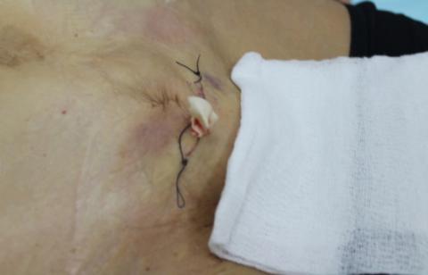 Внешний вид раны пациентки после удаления опухолевого образования мягких тканей лобковой области